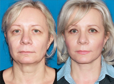 Facial rejuvenation - This patient underwent facial rejuvenation with facelift and blepharoplasty.
