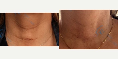 35-44 year old woman treated with Subcision - Patient came in with this surgical scar from a thyroidectomy. She was extremely self-conscious of the linear indent it left across her neck since it looked like a deep wrinkle. We were able to subcise the area and lift it back up after untethering the scar.