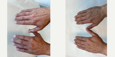 42 year old man treated with Lumecca for hands rejuvenation - Only 3 weeks after the first Lumecca treatment and this client already has brand new hands! He will come back for two more sessions to treat any stubborn leftover spots and underlying hyperpigmentation not visible to the naked eye that could become problematic later on.
