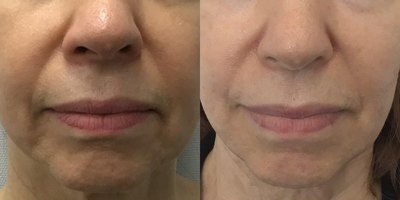 65-74 year old woman treated with Sofwave, Ultherapy, Skin Tightening - 69 year old woman treated with Sofwave and Ultherapy to lift cheeks and reduce facial lines