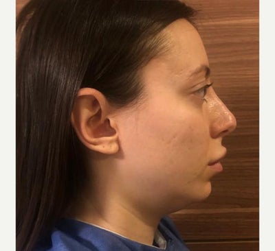 25-34 year old woman treated with Chin Liposuction - Neck Liposuction