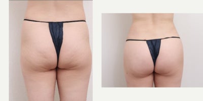 25-34 year old woman treated with Nonsurgical Butt Lift, Vaser Liposuction, Liposuction - 31 Years old female patientChief Complain: Hip dips, abdomen & flanks, saggy buttocksTreatment Plan: full abdomen liposuction /buttocks, hip dip, butt fat transfer injectionOutcome:- abdomen liposuction pure fat : 1200cc front/ 600cc back side- hip & butt curves enhanced- balanced upper & lower body shape