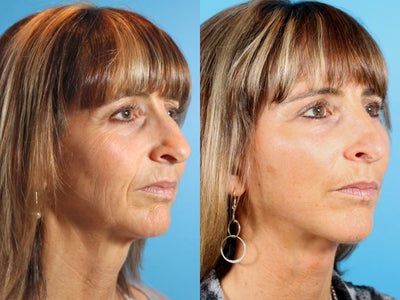 Facelift, Temple Lift, Upper Blepharoplasty - 	To create a more youthful, but entirely natural appearance, a Sub-SMAS facelift combined with upper eyelid surgery and a subcutaneous temple lift was performed. This results in a long-lasting, younger, more well-rested appearance.