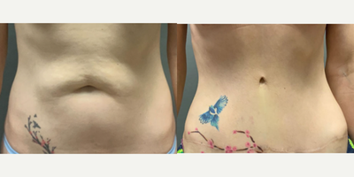 Woman treated with Tummy Tuck - Woman treated with Tummy Tuck