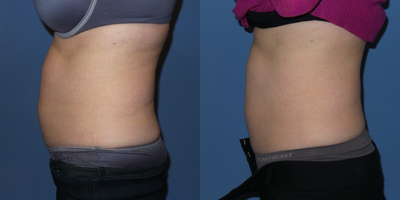 38 y/o female who was treated with SculpSure to her abdomen and flanks. - 38 y/o female who was treated with SculpSure to her abdomen and flanks.   She is shown 6 weeks after the procedure.