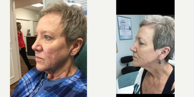 65-74 year old woman treated with EndyMed 3Deep - Post 4 Endymed Treatments