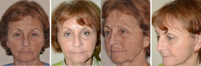 Laser Resurfacing and Full Facelift  - Female presented for aging facial concerns.  Laser resurfacing was performed along with a facelift.