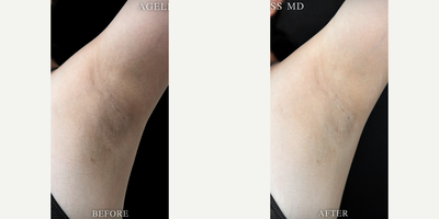 25-34 year old woman treated with Skin Lightening - 25-34 year old woman treated with Skin Lightening