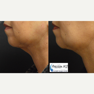 Bellafill before and after photo