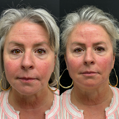 Cheek Fillers before and after photo