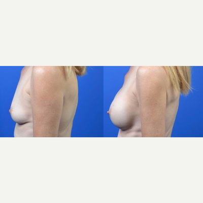 Breast Augmentation before and after photo