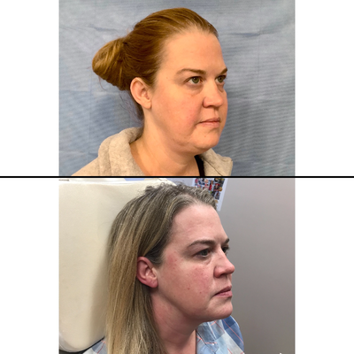 Ultherapy before and after photo
