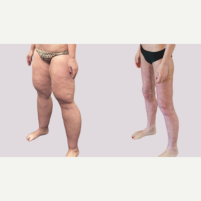Thigh Lift before and after photo