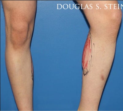 Calf Implants: Surgery, Recovery, Side Effects & Scars