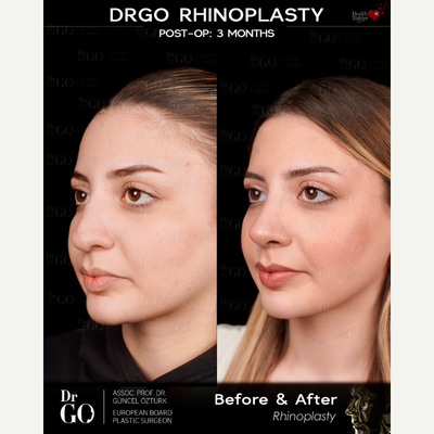 Rhinoplasty before and after photo