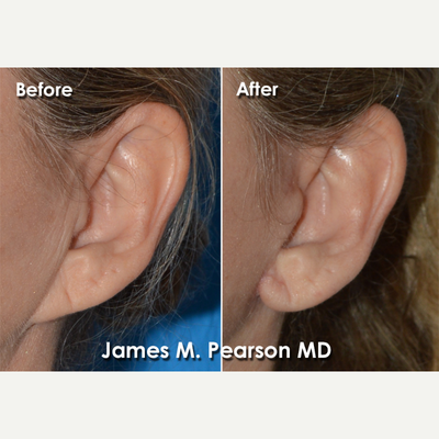 Earlobe Repair before and after photo