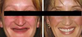 Dental Implants before and after photo