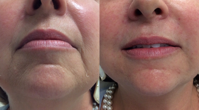 Restylane Refyne before and after photo