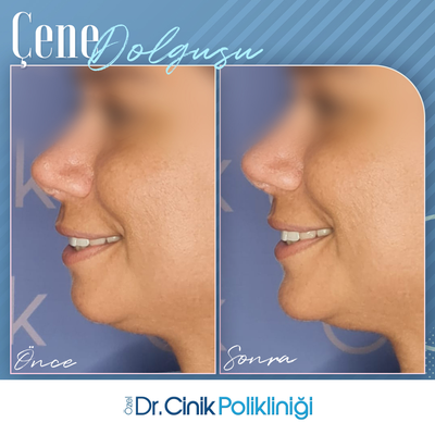 Chin Filler before and after photo