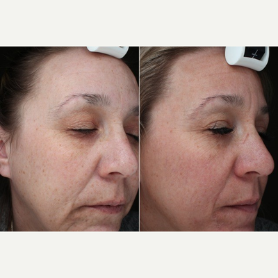 Fraxel Laser before and after photo