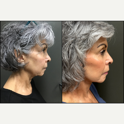 Facial Fat Transfer before and after photo