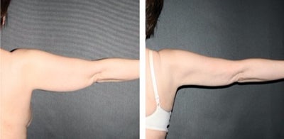 Liposuction before and after photo