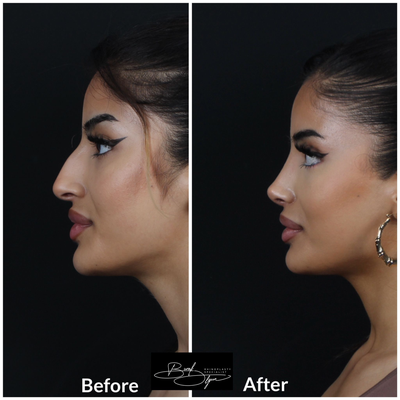 Rhinoplasty before and after photo