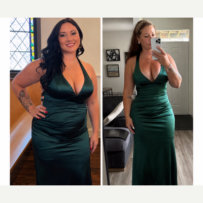 Liposuction before and after photo