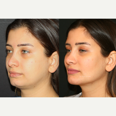 Facial Fat Transfer before and after photo