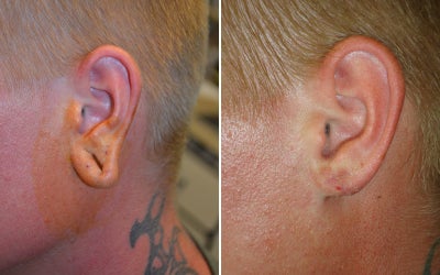Ear Surgery before and after photo