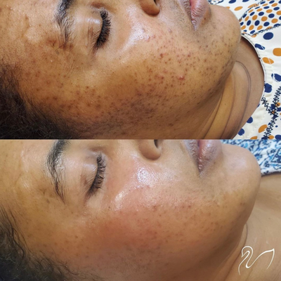 Chemical Peel before and after photo