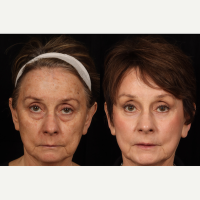 Liposculpture before and after photo