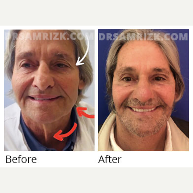 Neck Lift before and after photo