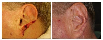 Mohs Surgery before and after photo