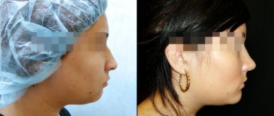 Chin Implant before and after photo