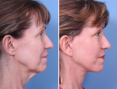 Lower Facelift before and after photo