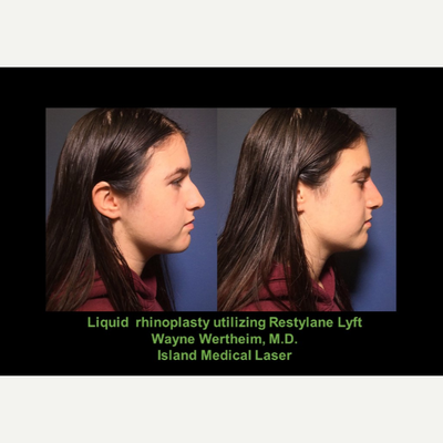 Nonsurgical Nose Job before and after photo