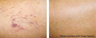 Vbeam before and after photo
