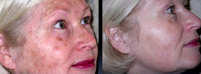 IPL before and after photo
