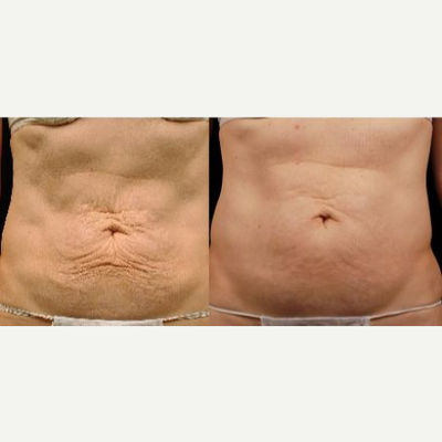 Thermage before and after photo