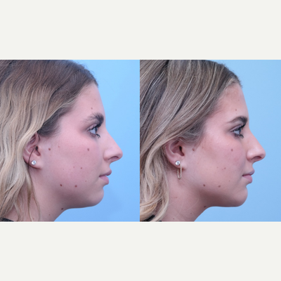 Chin Implant before and after photo