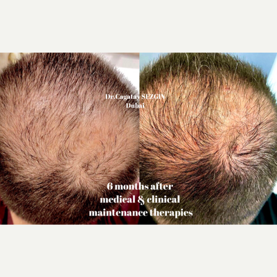 Hair Loss Treatment before and after photo