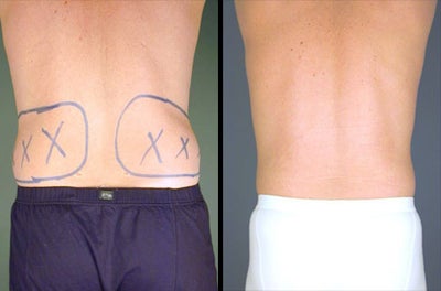 Smart Lipo before and after photo