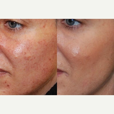IPL before and after photo
