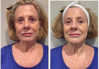 Facial before and after photo