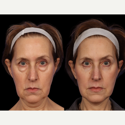 Facelift before and after photo