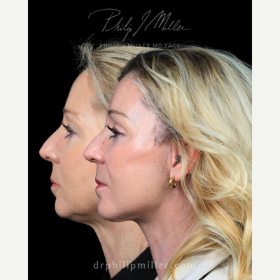 Neck Lift before and after photo