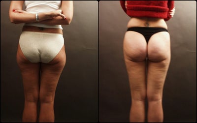 Liposuction before and after photo