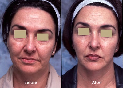 Liposuction before and after photo