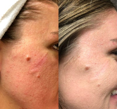 Skin Rejuvenation before and after photo